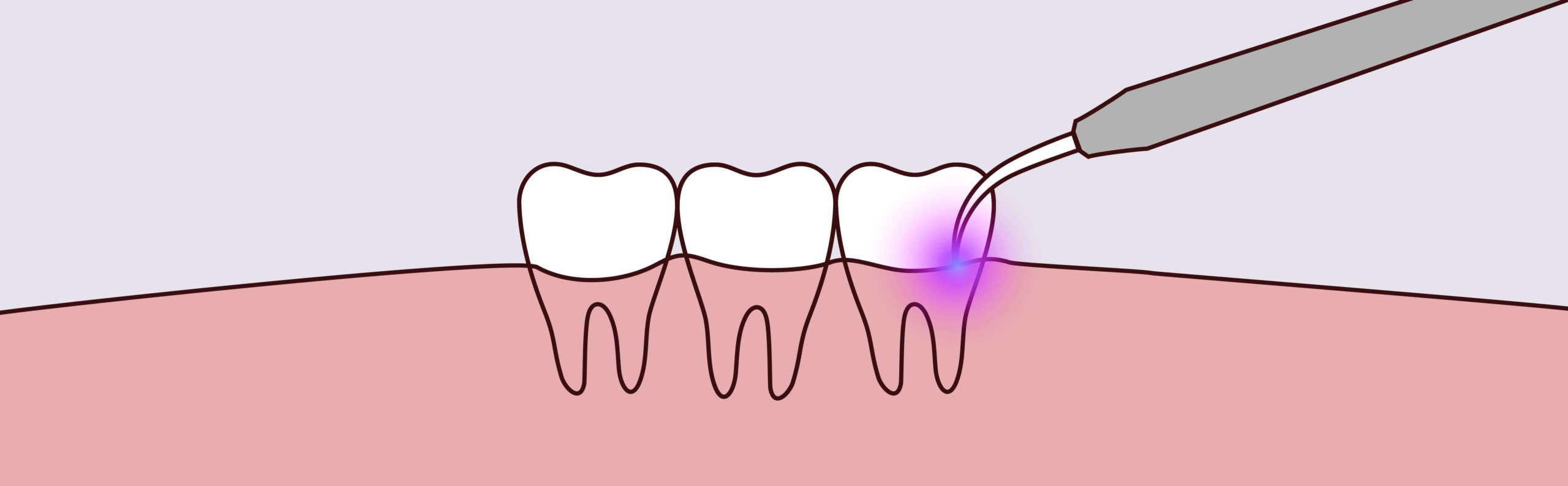 Laser Therapy - Z Dental Care - Dreamscape Imagery 03 scaled - Z Dental Care -