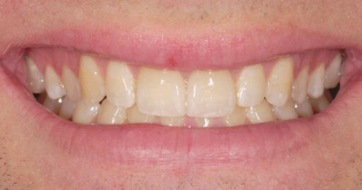 Teeth-2-After